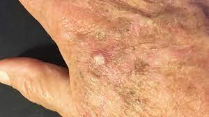 Actinic Keratosis Treatment Market Future Demands, Emerging Technologies and Forecast 2032