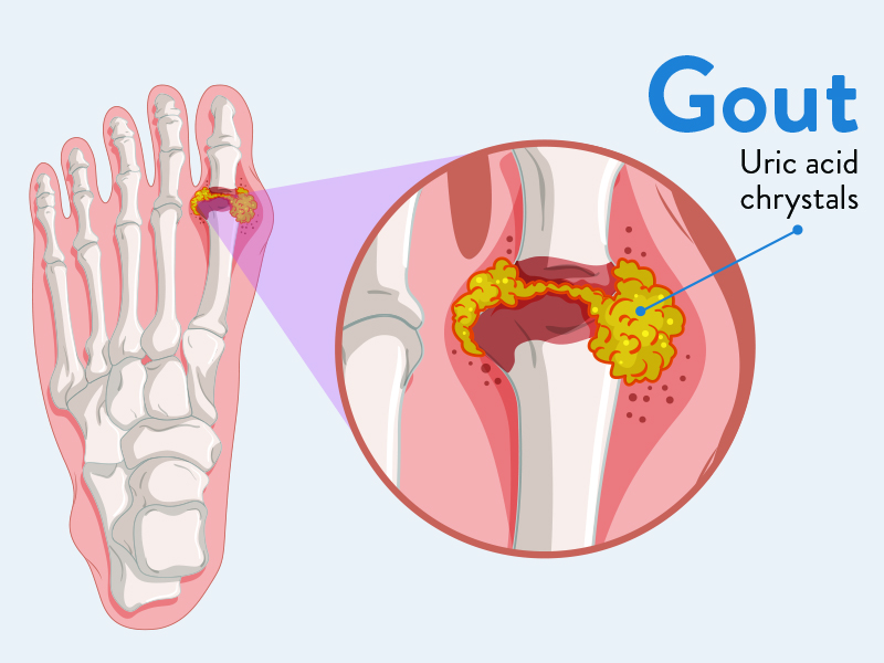 Trusted Care with GCSP: Finding the Right Gout Doctor Near Me